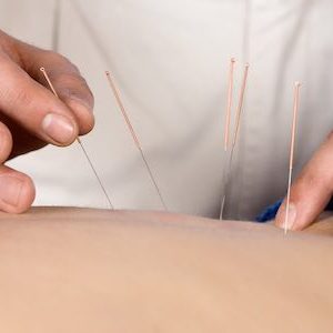 Physiotherapist doing accupuncture